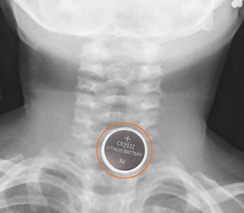 xray_of_battery_in_throat